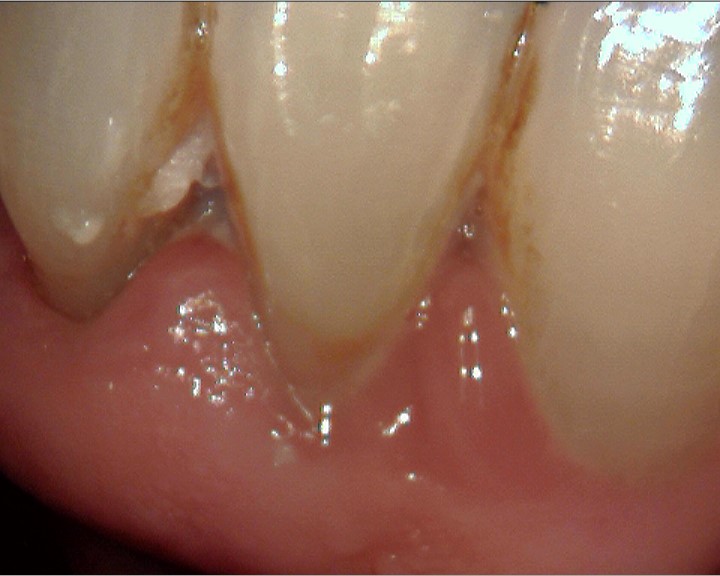 Zahnfleischrückgang - eitrige, unbehandelte Parodontose