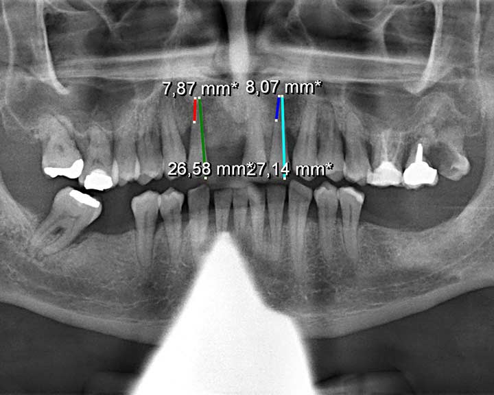 Zahnfleischrückgang - eitrige, unbehandelte Parodontose