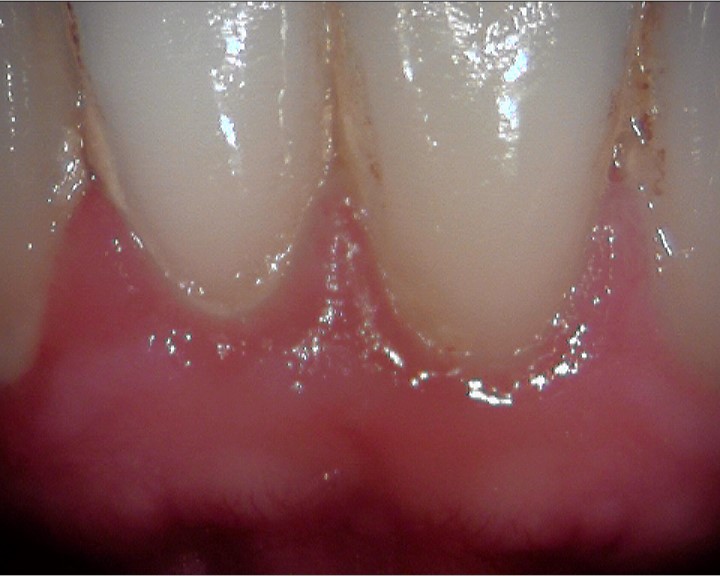 Eitrige Parodontitis mit Zahnfleischrückgang