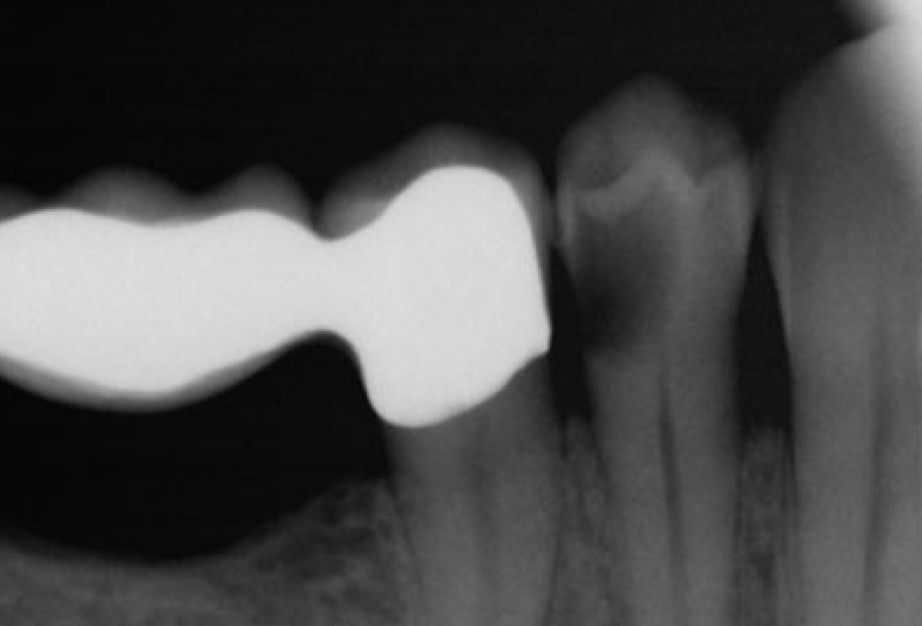 tief kariös zerstörter Zahn (dunkler Schatten)