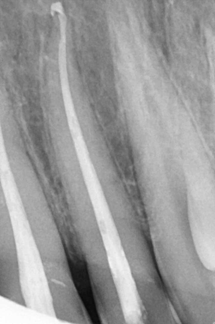 Mikroskopische Endodontie - fachgerechte Wurzelfüllung