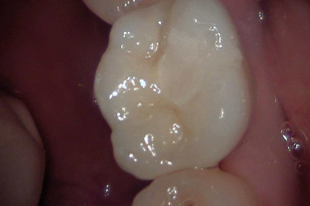 Zahn kariesfrei