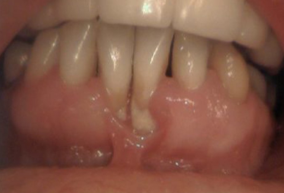 Zahnfleischrückgang– eitrige, unbehandelte Parodontose