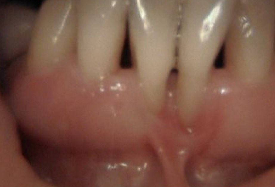 Teilweise Zahnfleischregeneration