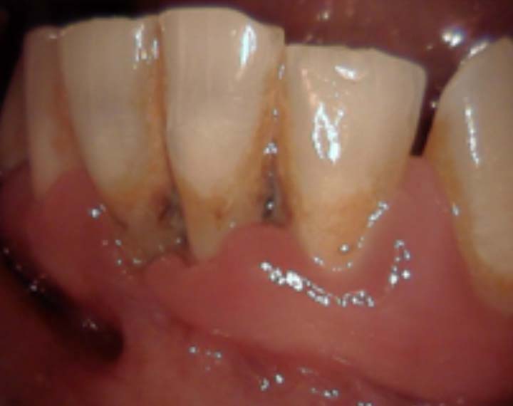 Eitrige Parodontitis mit Zahnfleischrückgang