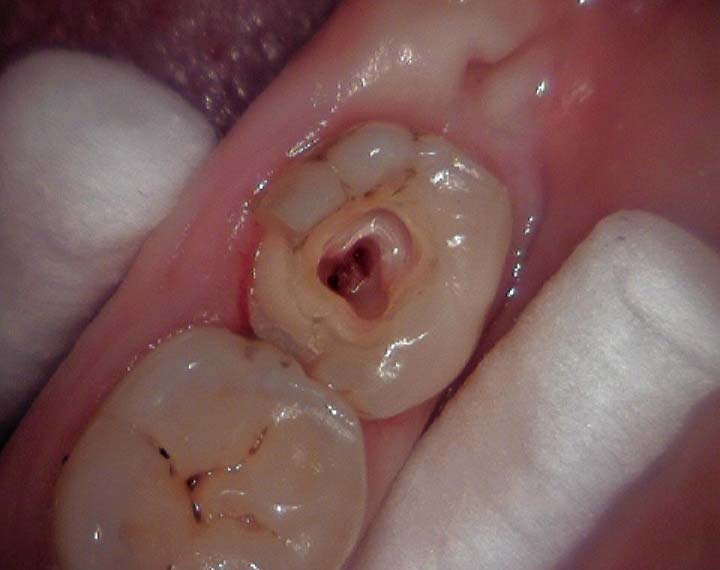 geöffneter Zahn bei einer Wurzelbehandlung